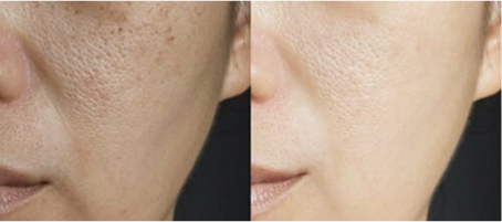 Burnt Skin → Calmed & Glowing in a Week